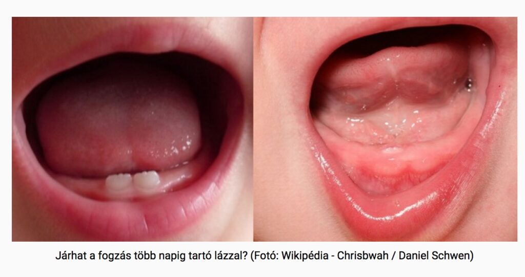 Can Teething Cause Fever Oakwood Dental